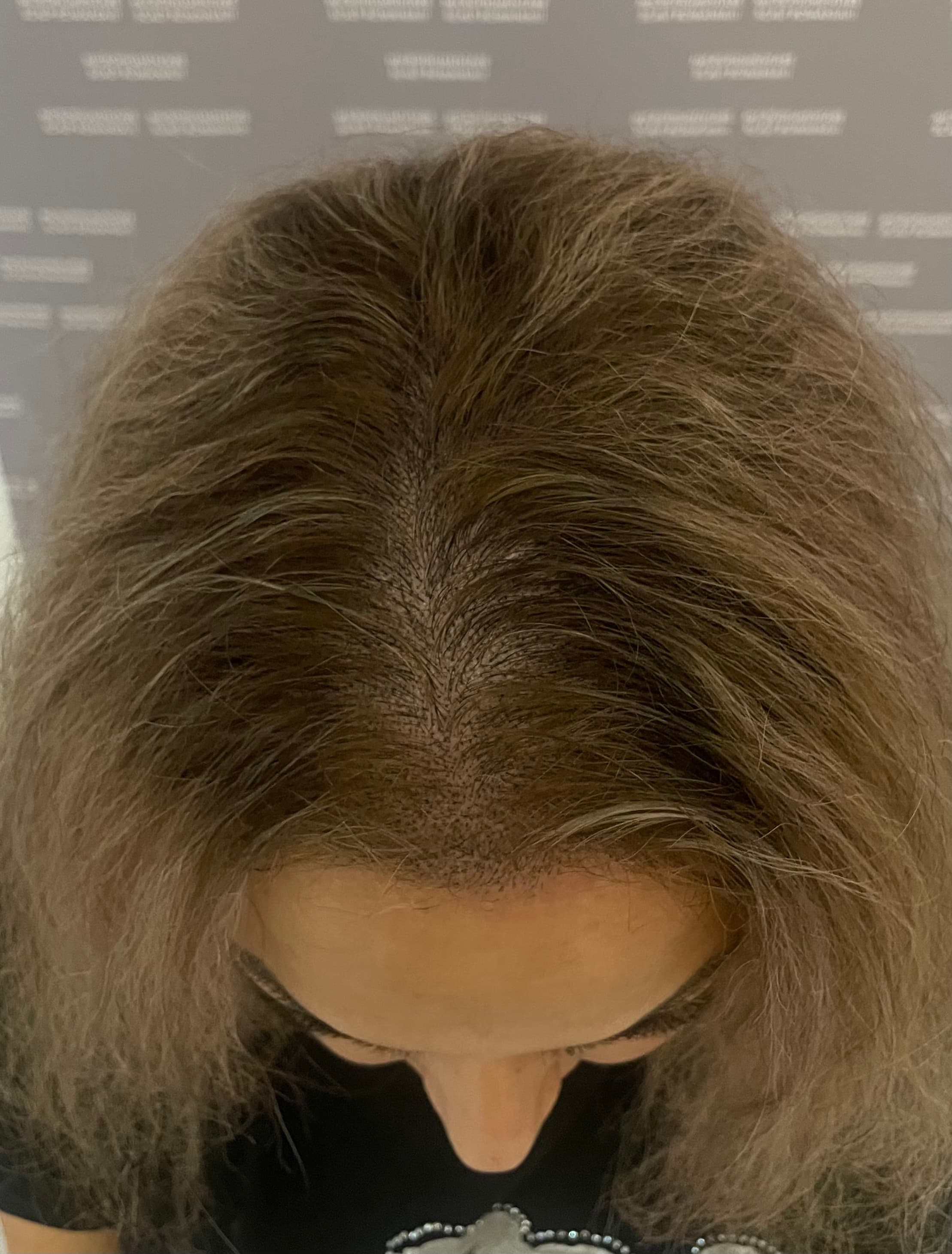 După micropigmentare scalp - Micropigmentare Scalp Femei