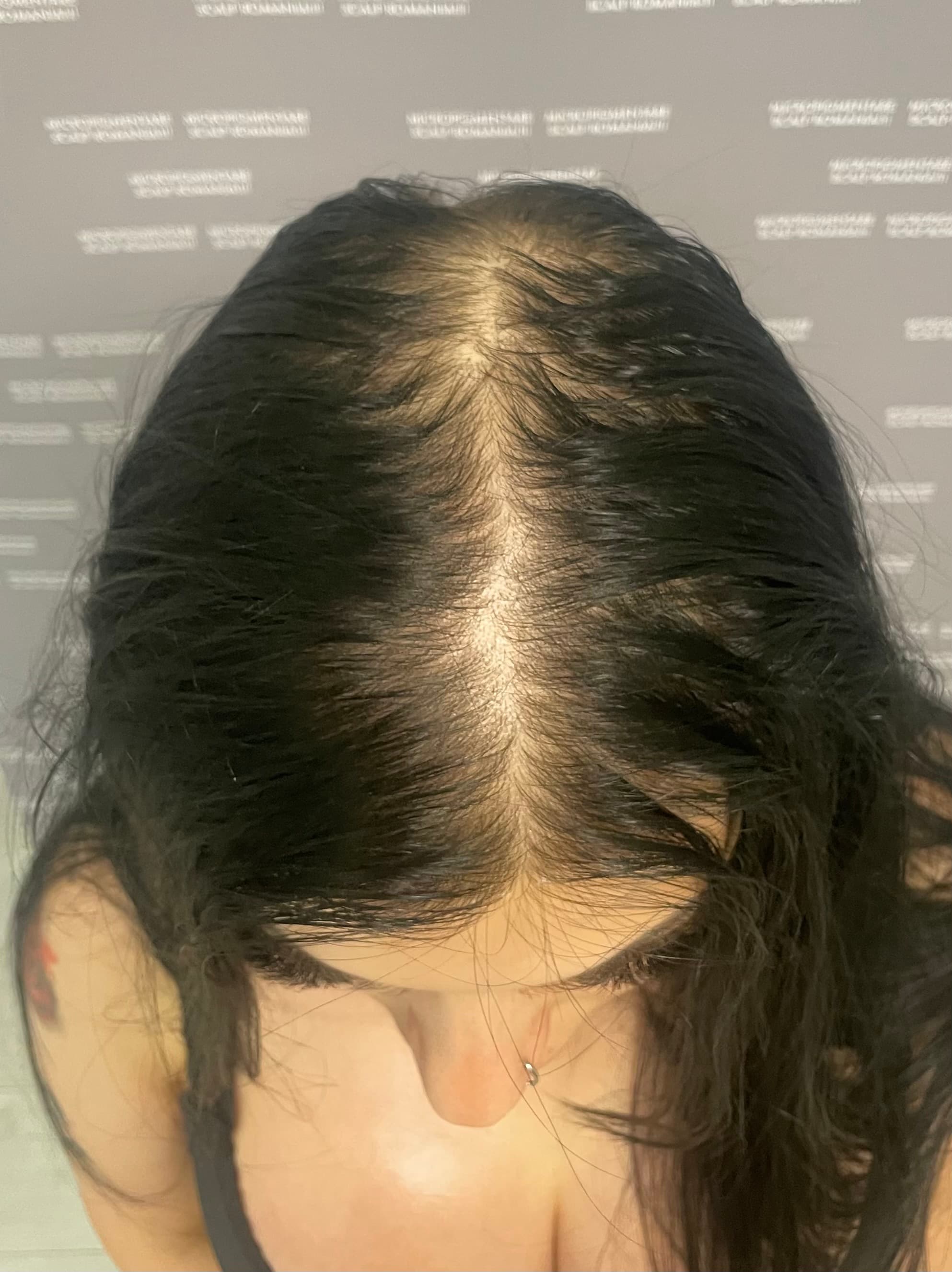 Înainte de micropigmentare scalp - Micropigmentare Scalp Femei