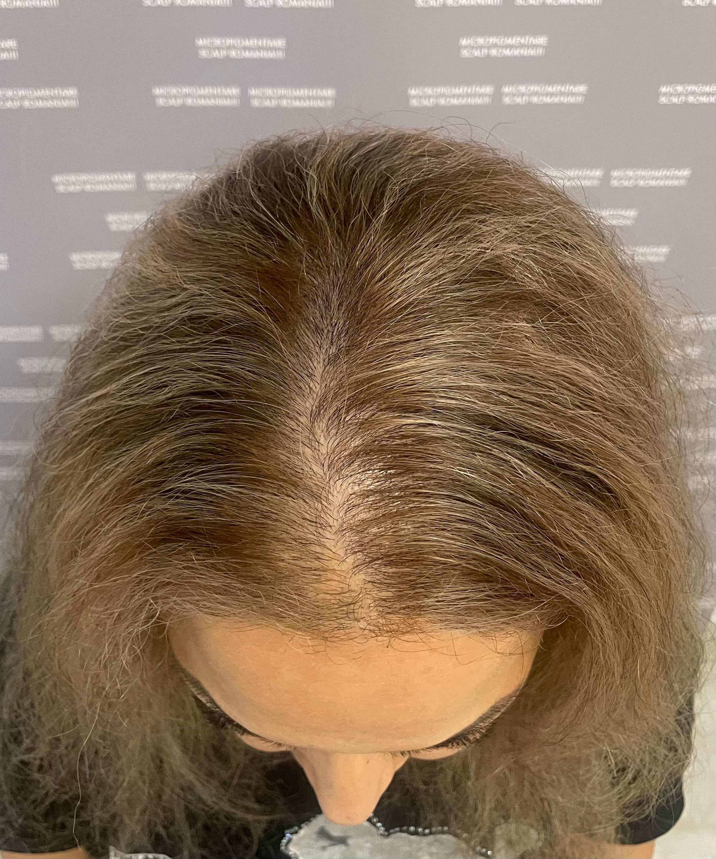 Înainte de micropigmentare scalp - Micropigmentare Scalp Femei